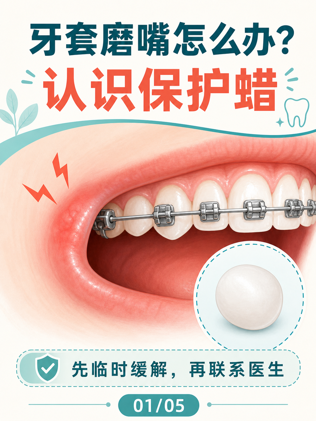 牙套磨嘴怎么办?认识保护蜡